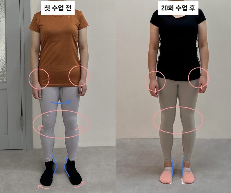 필라테스 첫 수업 전과 20회 수업 후 앞모습 비교 — 무릎·발 정렬 변화